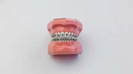 Comparison of the week: Braces vs Invisalign