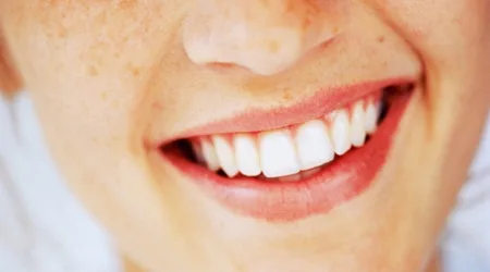 Invisalign | How it works, what it costs and how it compares