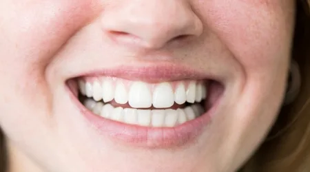 SmilePro teeth whitening overview