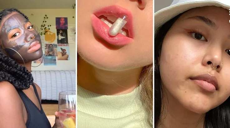 ZitSticka Rundown: Do you know what type of pimple you have?
