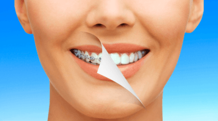 Teeth straightening | Compare options, costs and treatment times