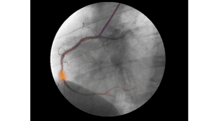 can i get health insurance after angioplasty