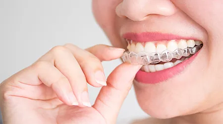 Invisalign financing: What are your payment options?